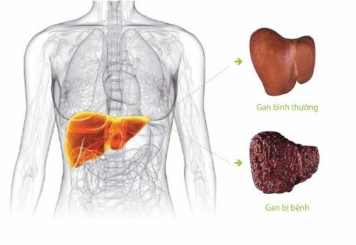 Nutritional Status Of Patients With Cirrhosis - Công Ty Cổ Phần Dược 